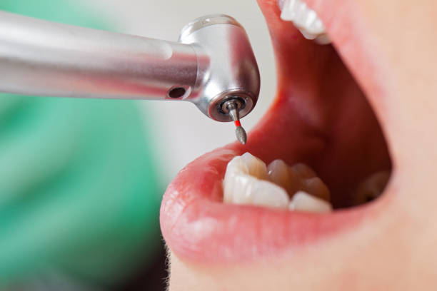 Best Emergency Dental Extractions in Newton Falls, OH